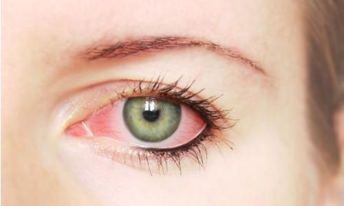 Красные глаза: почему, что делать? Лечение у взрослых, ребенка - офтальмологический центр Ирис